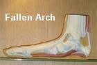 Fallen arches