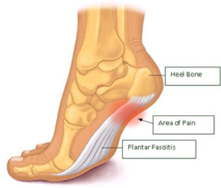 Painful sole of the foot