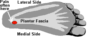 Plantar Fascia Pain